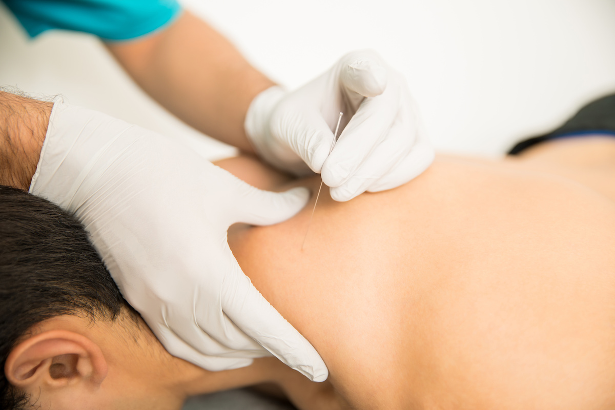 receiving dry needling therapy from chiropractor in chiropractic wellness center